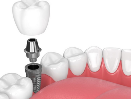 种牙多少钱一颗啊？揭秘种植牙的价格与选择！