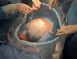 浙江妈妈早产生下"双胞胎哪吒"：现代医学创造的生命奇迹